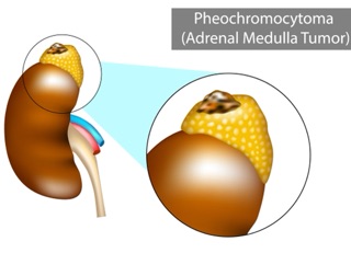 Feochromocytóm, feochromoblastóm, paraganglióm, neuroblastóm